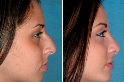 Things involved in the rhinoplasty procedure