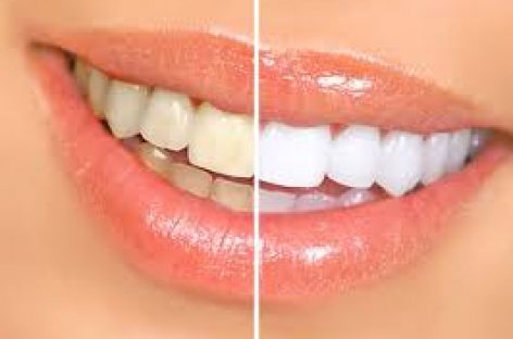 Natural ways to treat yellow teeth successfully