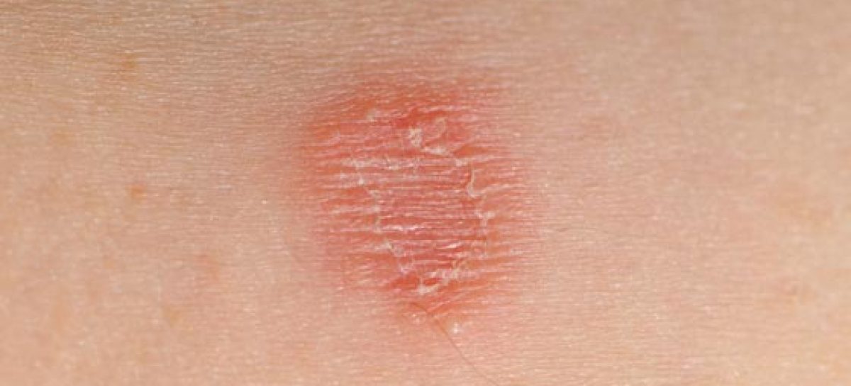 Proven home remedies for skin rashes