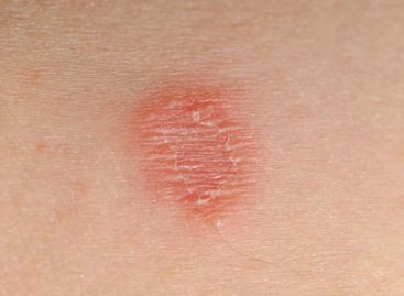 Proven home remedies for skin rashes