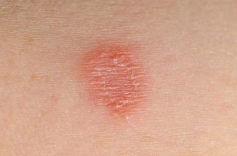 Proven home remedies for skin rashes