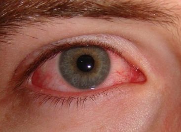 The most common natural treatments for dry eye syndrome