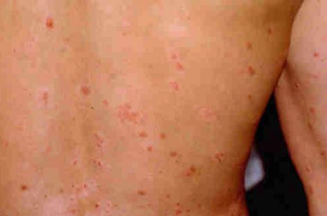 The most useful home remedies for psoriasis