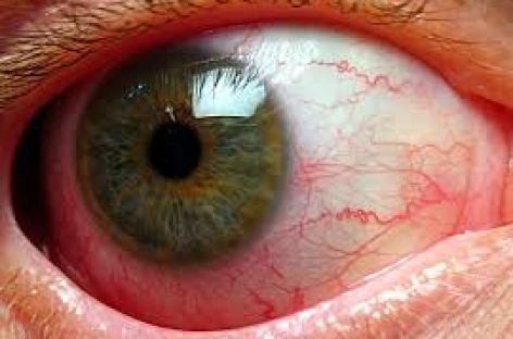 Home remedies for red eyes problems