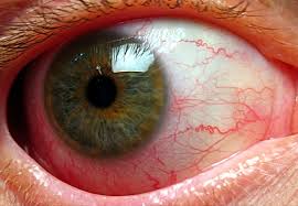 red eyes