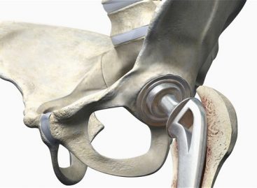 How to Recognize the Early Warning Signs of Needing a Hip Replacement