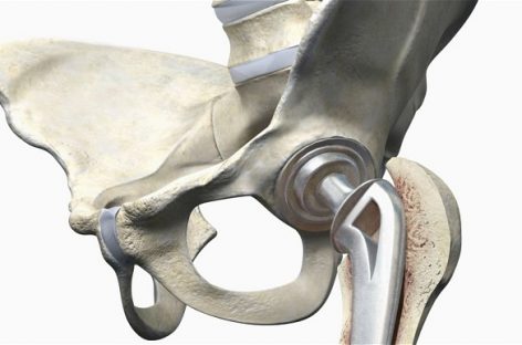 How to Recognize the Early Warning Signs of Needing a Hip Replacement