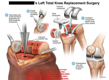 The Secret to a Successful Recovery After Knee Arthroplasty Surgery