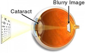 cataract1a