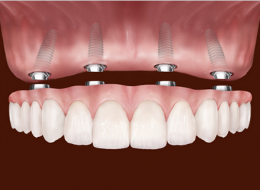 How Dental Implants are Done?