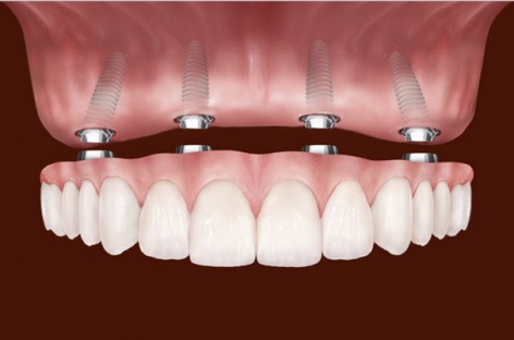 How Dental Implants are Done?