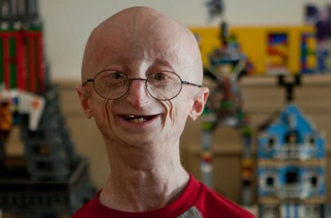 Knowing Progeria, an aging disease caused by gene mutation