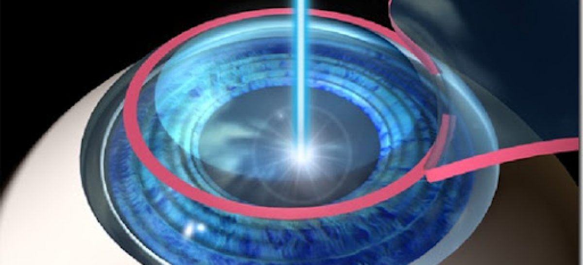 Lasik, a permanent solution for nearsighted problems