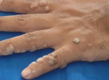 Home Remedies for Warts