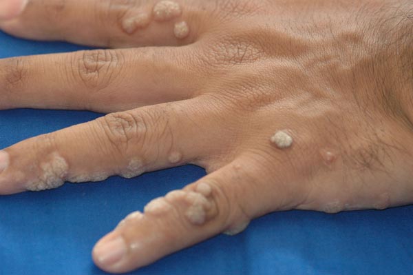 Warts