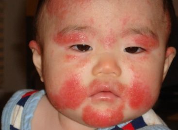 Infant allergies: The types and how to cope with