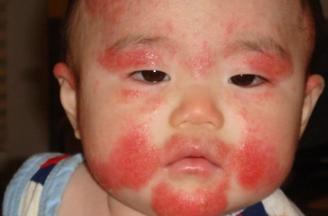 Infant allergies: The types and how to cope with