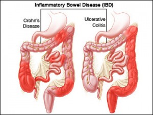 Inflammatory Bowel Disease1