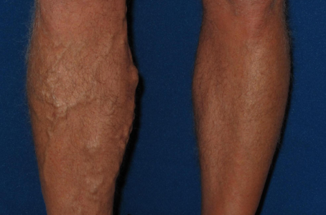 What is varicose vein and how to find the treatment options?
