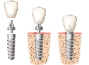 Face the world with confidence and opt for dental replacement by expert dentists