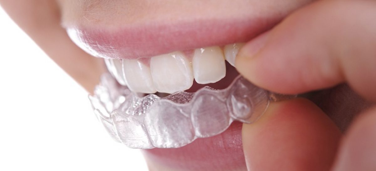 All about orthodontics invisalign
