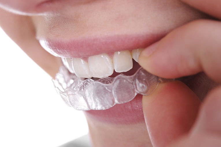 invisalign clear braces