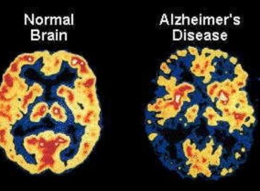 Know how to cure the Alzheimer’s disease
