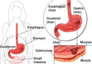 peptic ulcer1