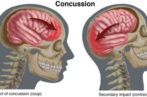 Concussion Rates Are on the Rise for Kid