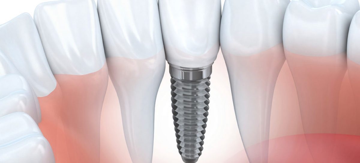 Who is a Good Candidate for Dental Implants