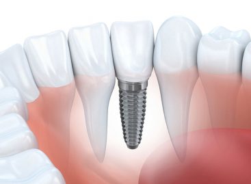 Who is a Good Candidate for Dental Implants