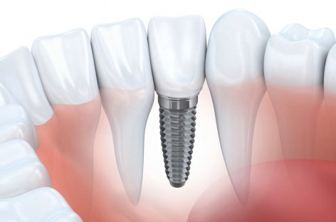 Who is a Good Candidate for Dental Implants