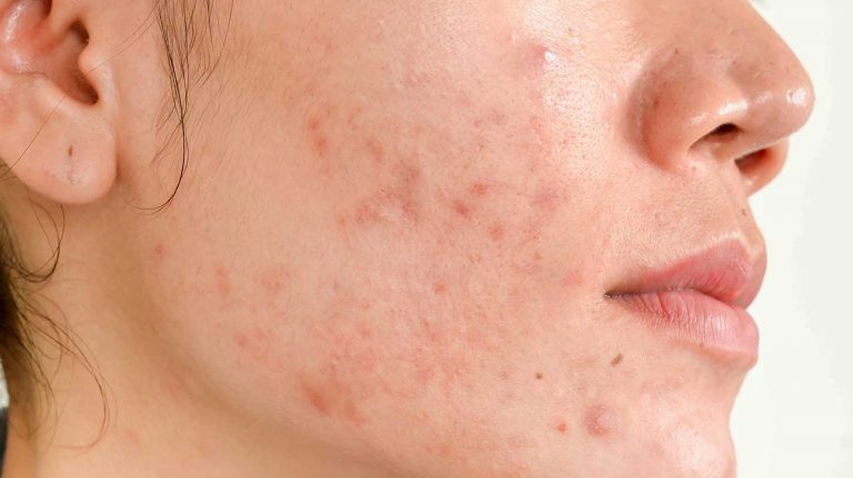 Acne Scars