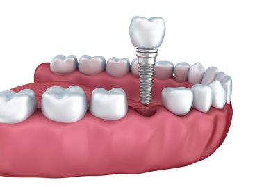 Things You Probably Didn’t Know About Dental Implants