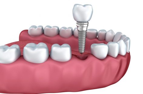 Things You Probably Didn’t Know About Dental Implants
