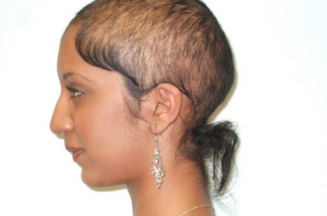 How Women Can Deal With Thin Hair After Taking Testosterone