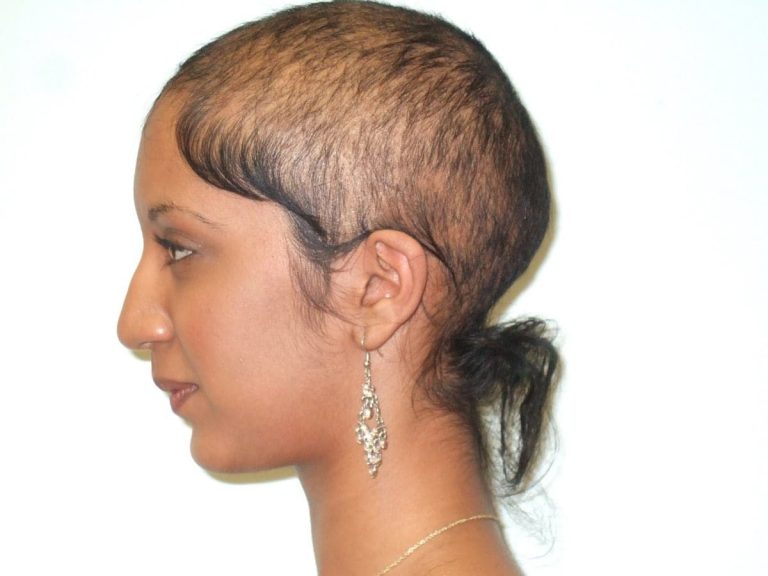 Thin Hair