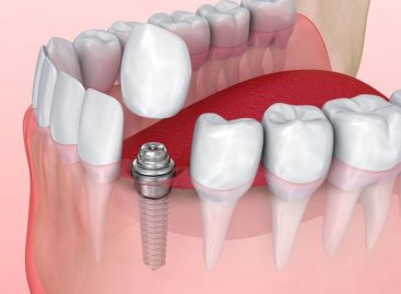 Can You Live Without Dental Implants