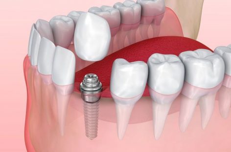 Can You Live Without Dental Implants