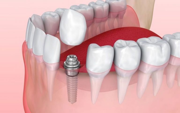 Dental Implants