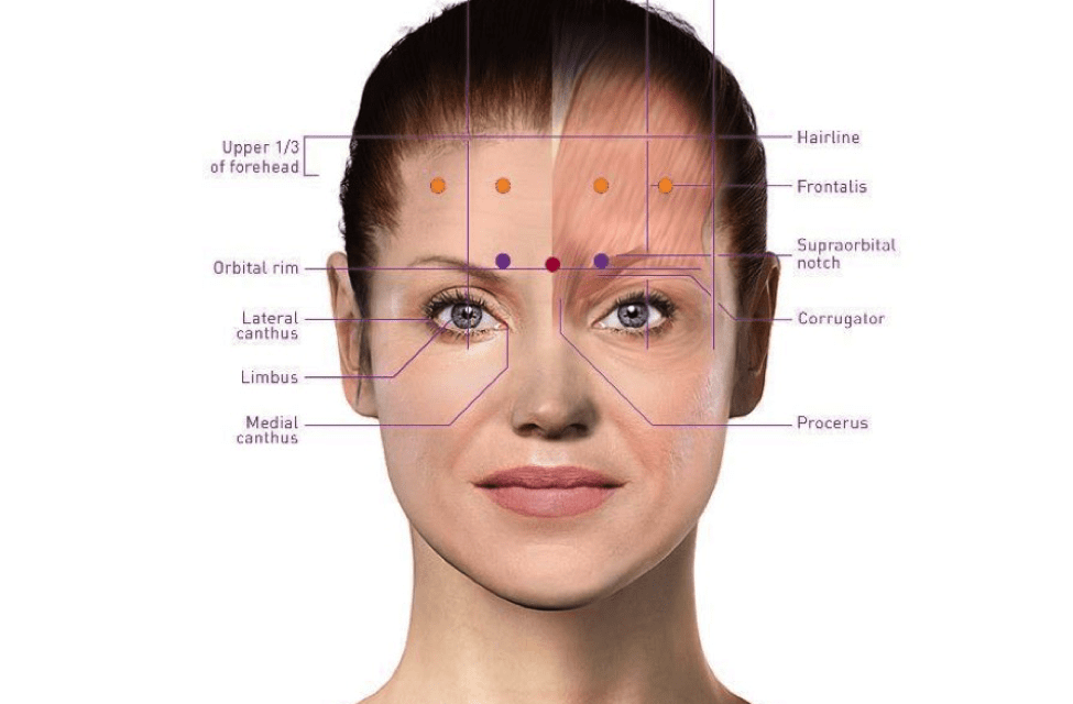 Migraines With Botox