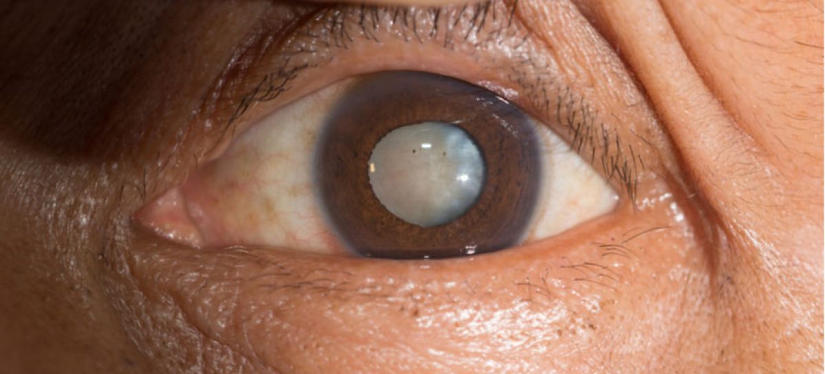Learn More About These 3 Types of Cataracts