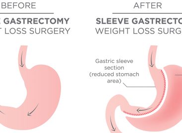 5 Things to Remember After Weight-Loss Surgery