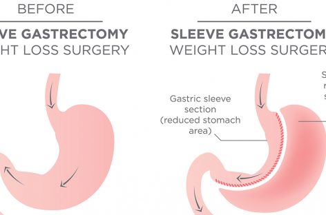 5 Things to Remember After Weight-Loss Surgery