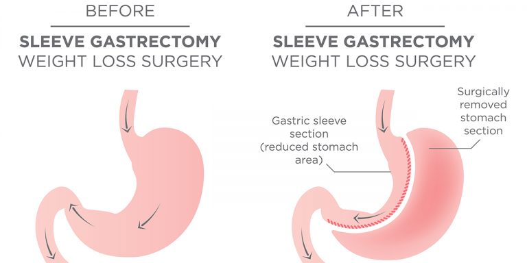 Weight-Loss Surgery