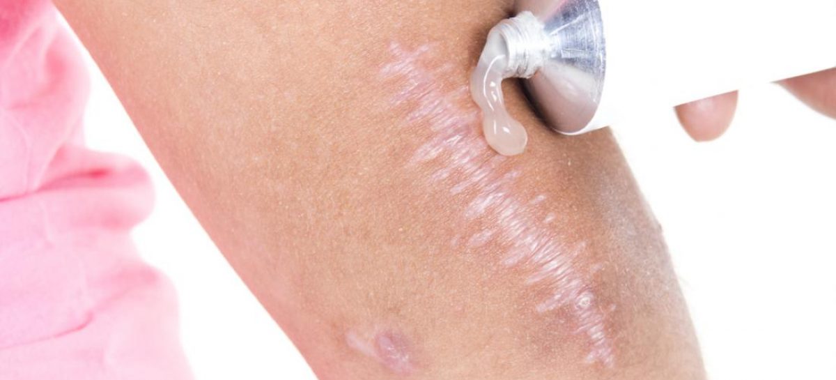 What You Need To Know About Treating and Minimizing Old Scars