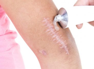 What You Need To Know About Treating and Minimizing Old Scars