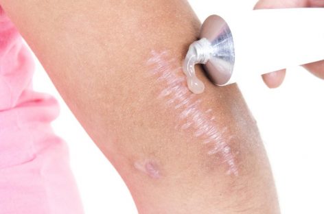 What You Need To Know About Treating and Minimizing Old Scars