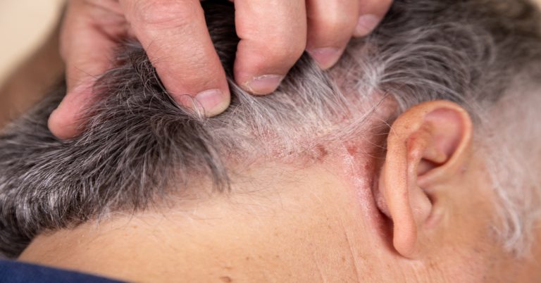 Psoriasis Vulgaris, psoriatic skin disease in hair, skin patches