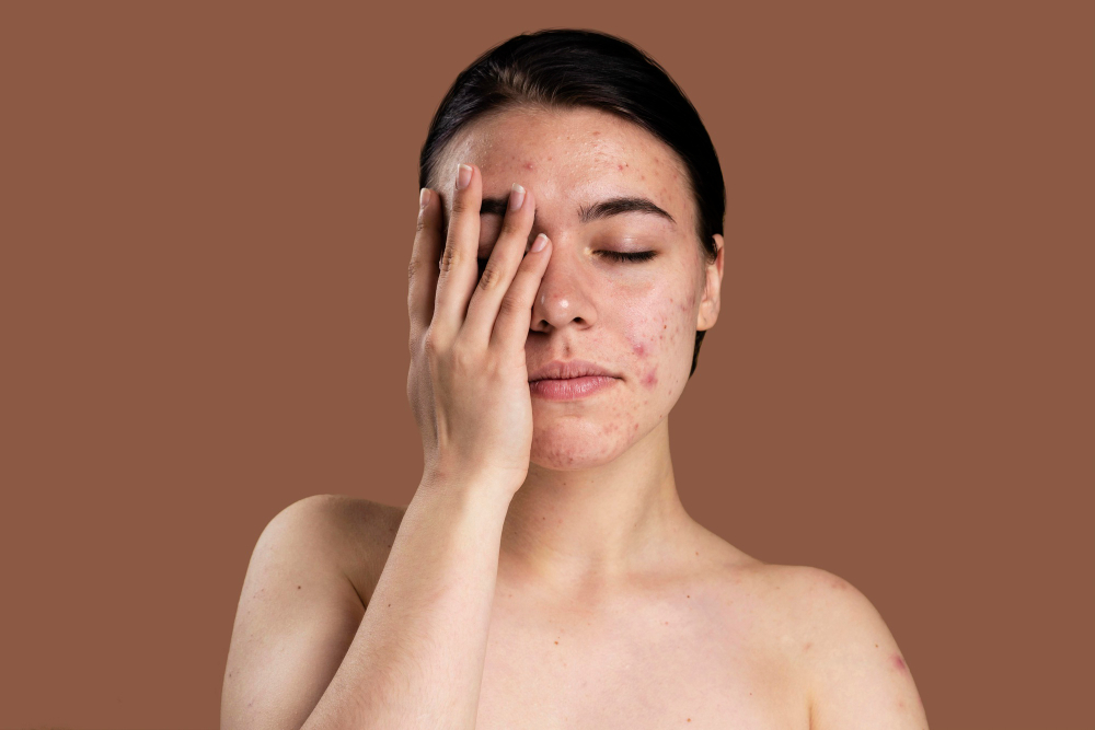 Psoriatic Arthritis: Relief from the Symptoms Psoriasis Vulgaris, psoriatic skin disease in hair, skin patches